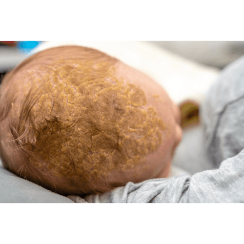 Cradle Cap