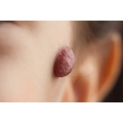 Hemangioma