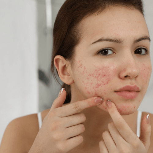 adolescent acne