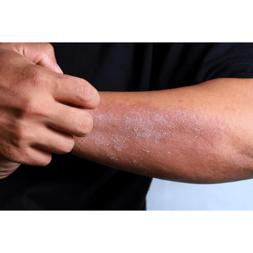 Eczema