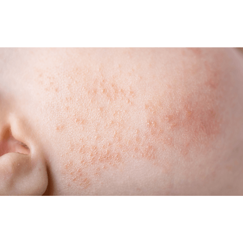 atopid dermatitis