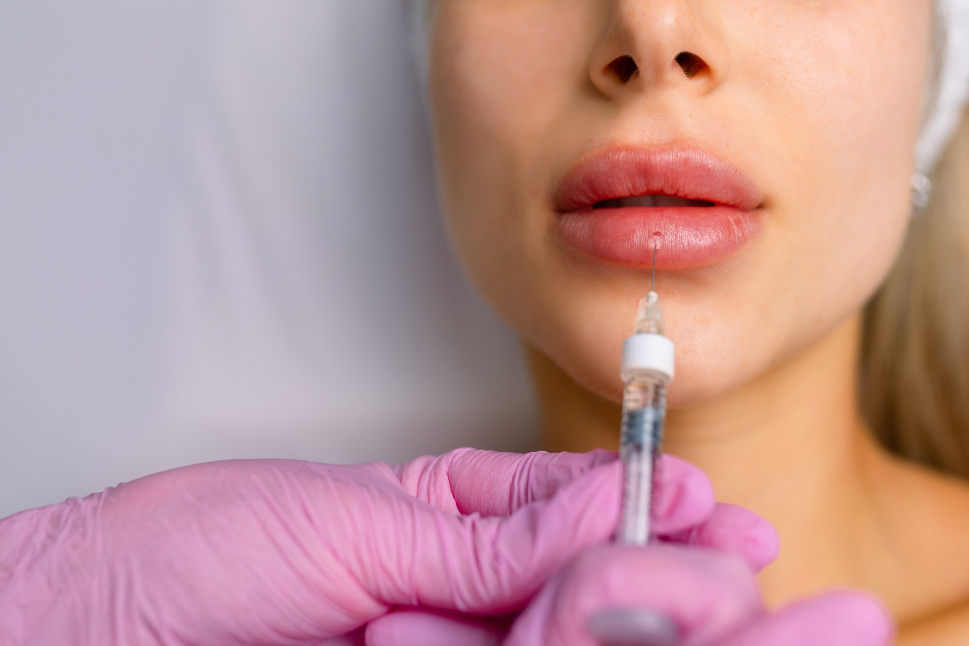 Injection procedure for lip augmentation, close