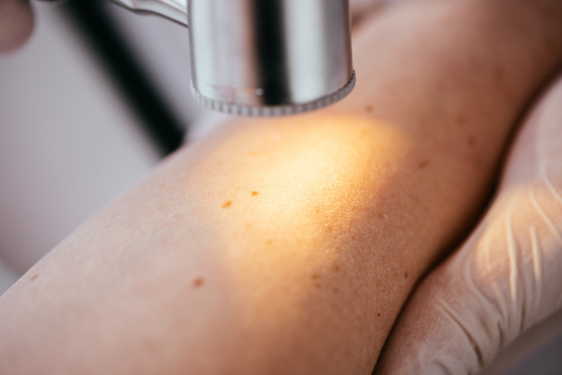 close up of dermatologist holding dermatoscope while examining hand of patient with melanoma